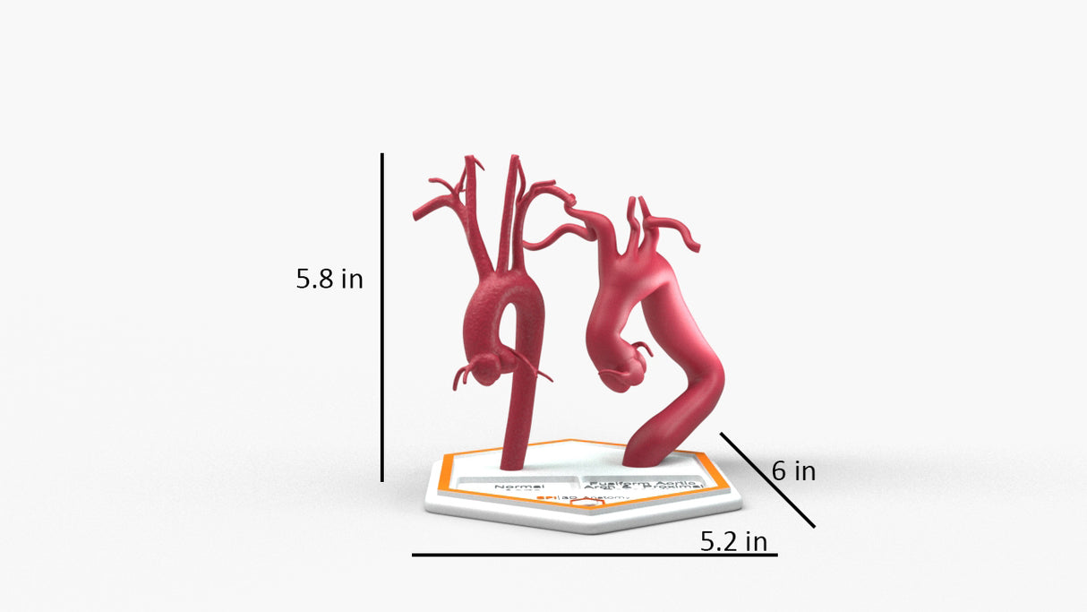 Aortic Arch - Normal and Fusiform with Proximal Descending Aneurysm