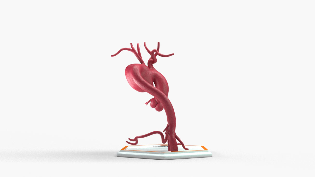 Aortic Arch - Focal Sacular Aneurysm