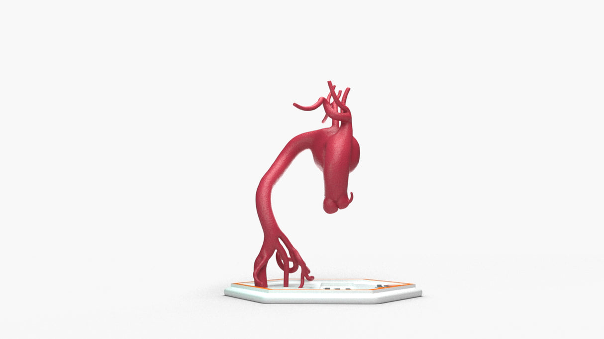 Aortic Arch - Focal Sacular Aneurysm
