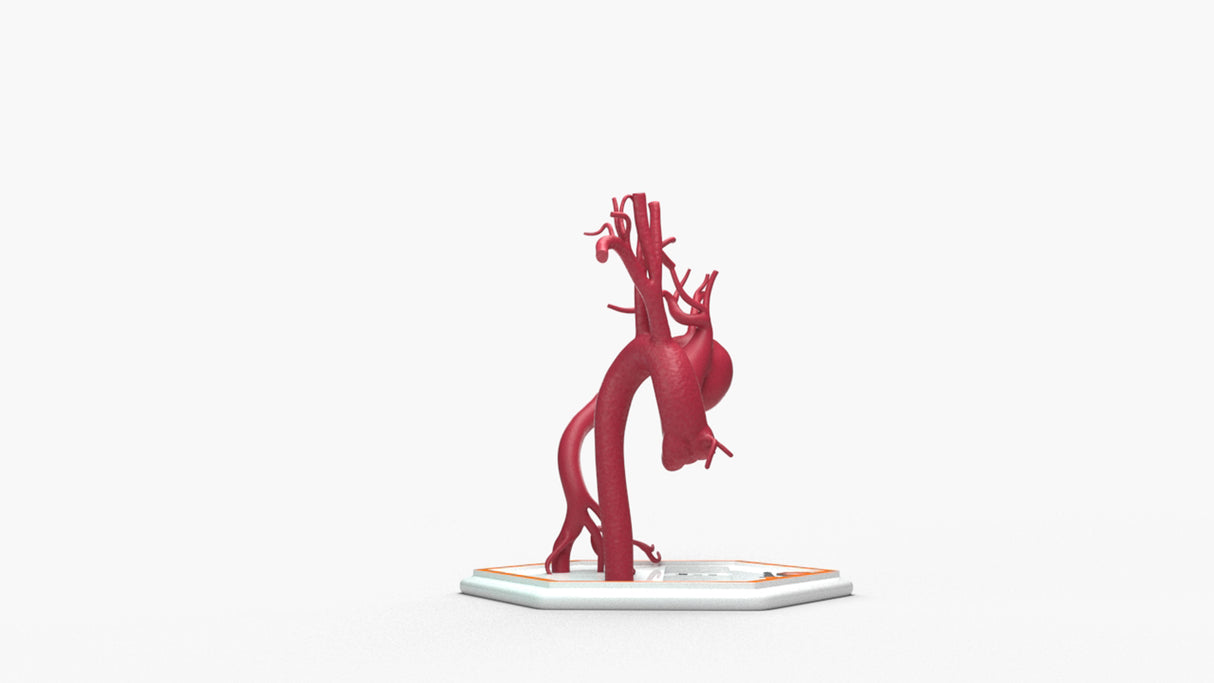 Aortic Arch - Normal and Focal Sacular Aneurysm