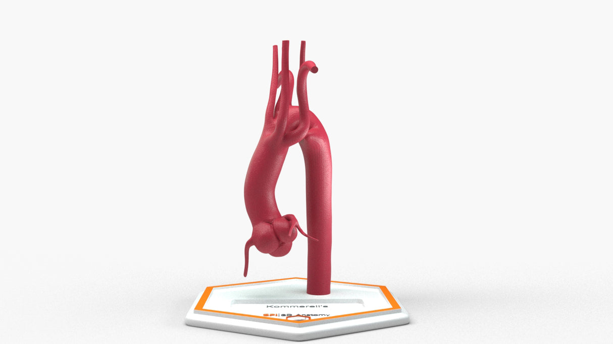 Kommerell's Diverticulum
