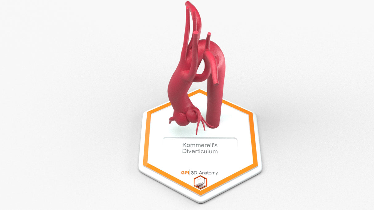 Kommerell's Diverticulum