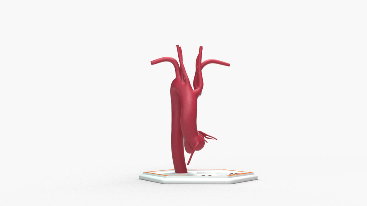 Kommerell's Diverticulum