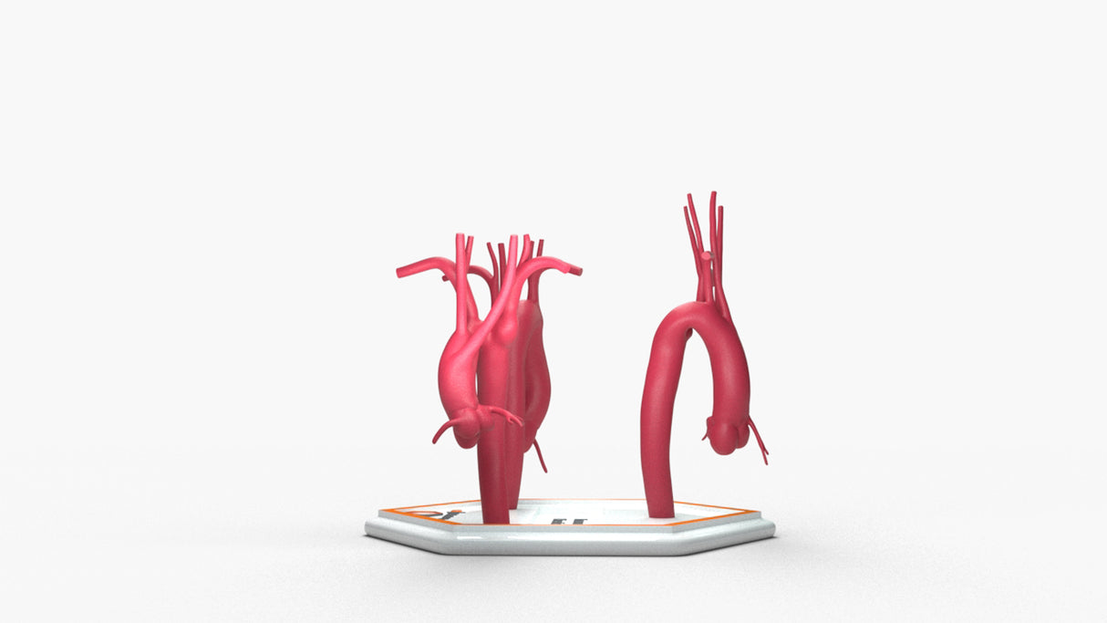 Kommerell's Diverticulum Series
