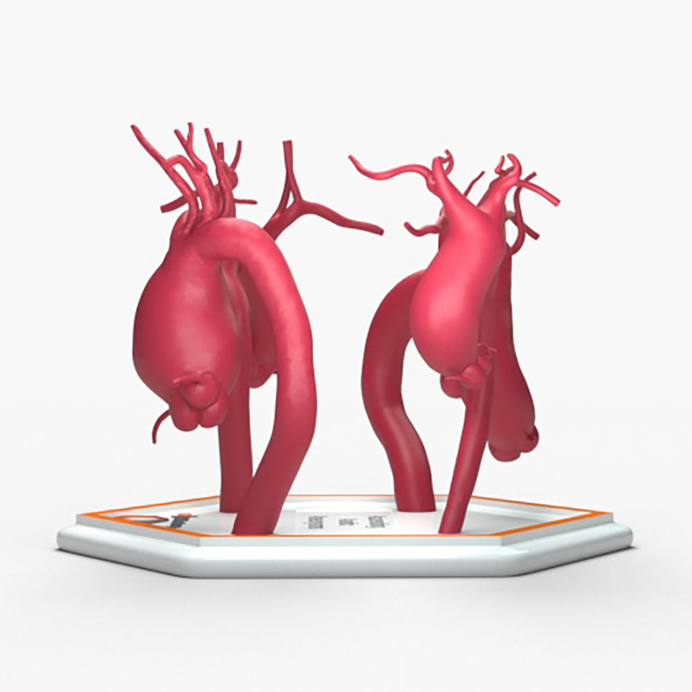 Ascending Aortic Aneurysms 1