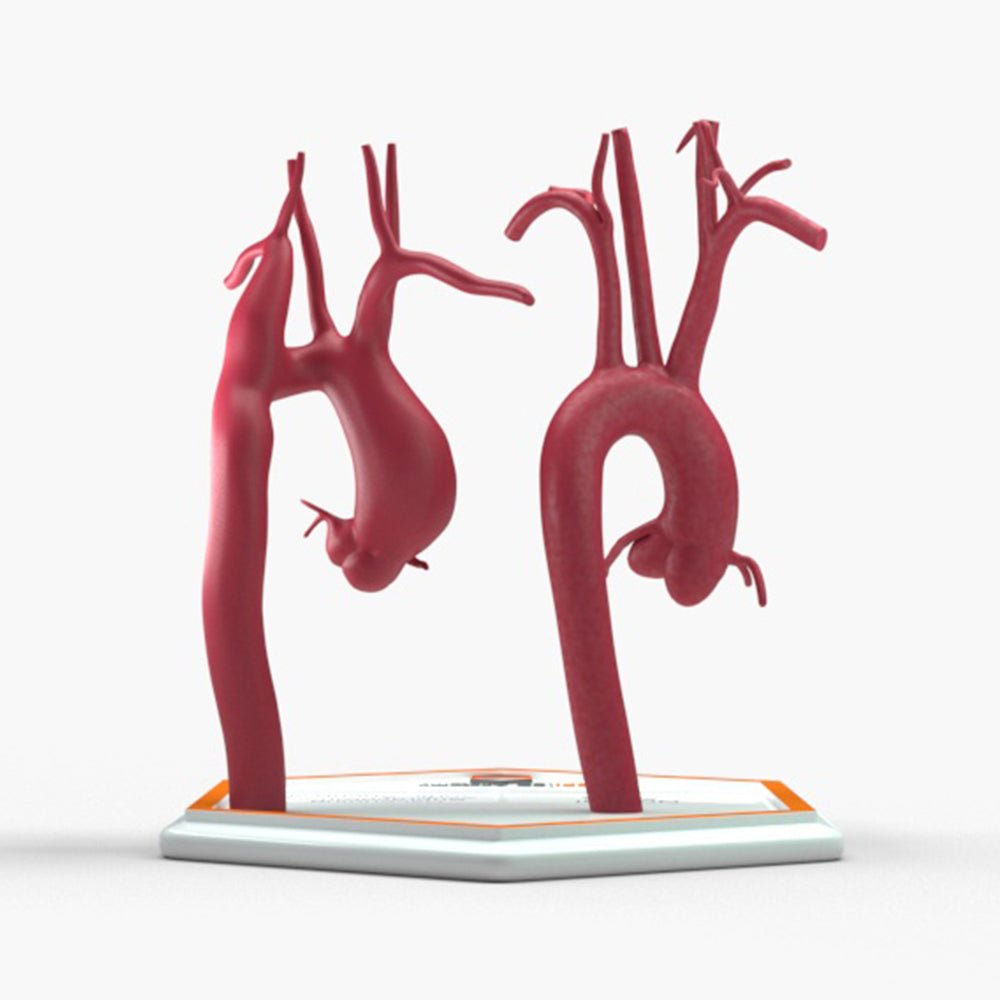 Ascending Supracoronary Aortic Aneurysm and Normal