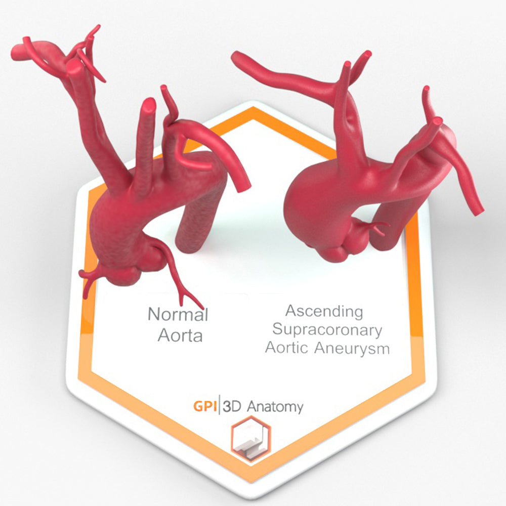 Ascending Supracoronary Aortic Aneurysm and Normal