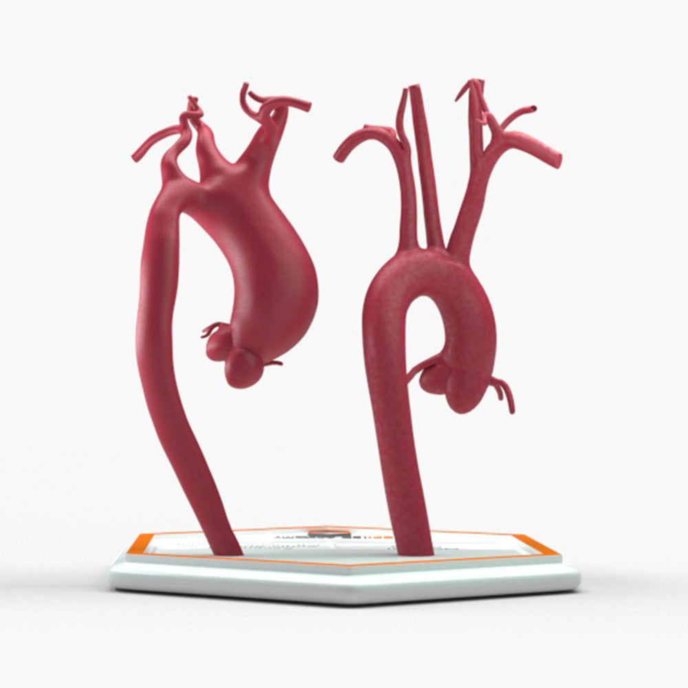 Supracoronary Ascending Aortic Aneurysm Left Carotid Variant and Normal
