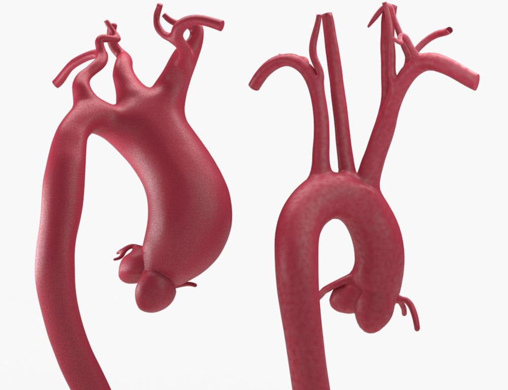 Supracoronary Ascending Aortic Aneurysm Left Carotid Variant and Normal