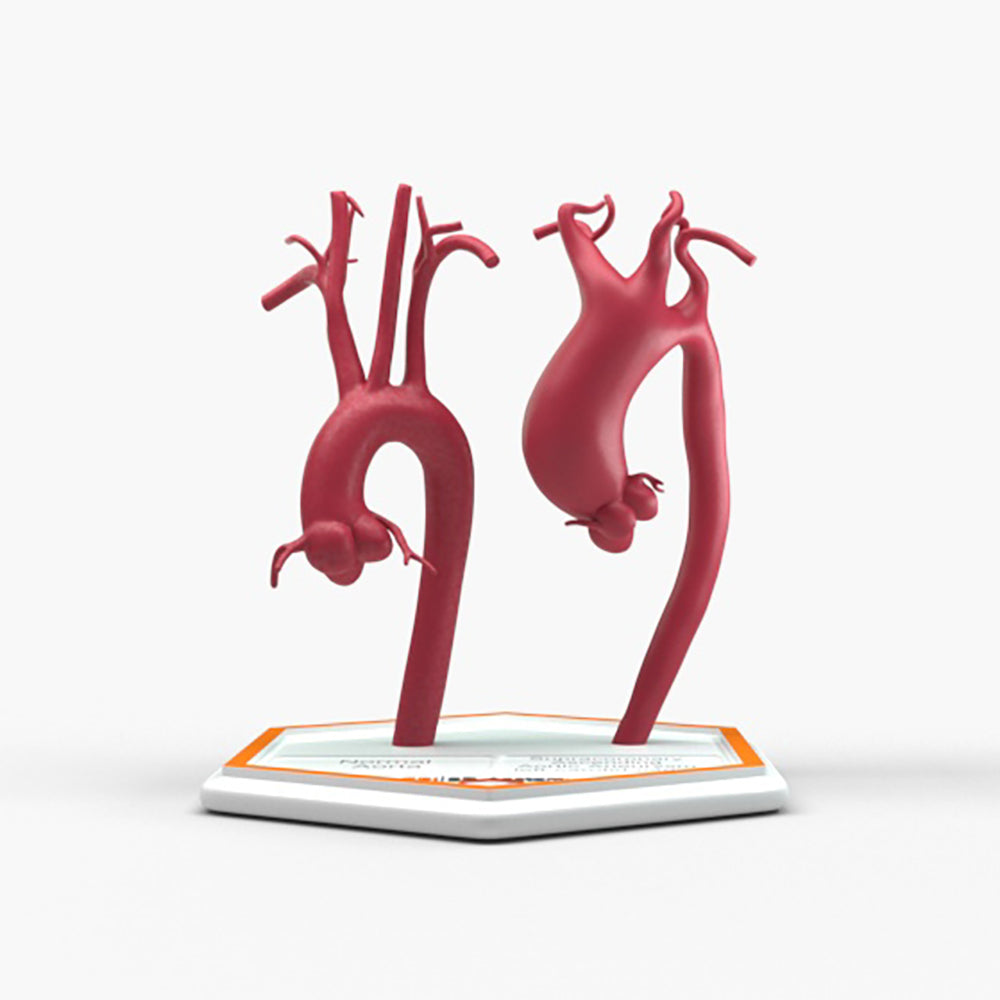Supracoronary Ascending Aortic Aneurysm Left Carotid Variant and Normal