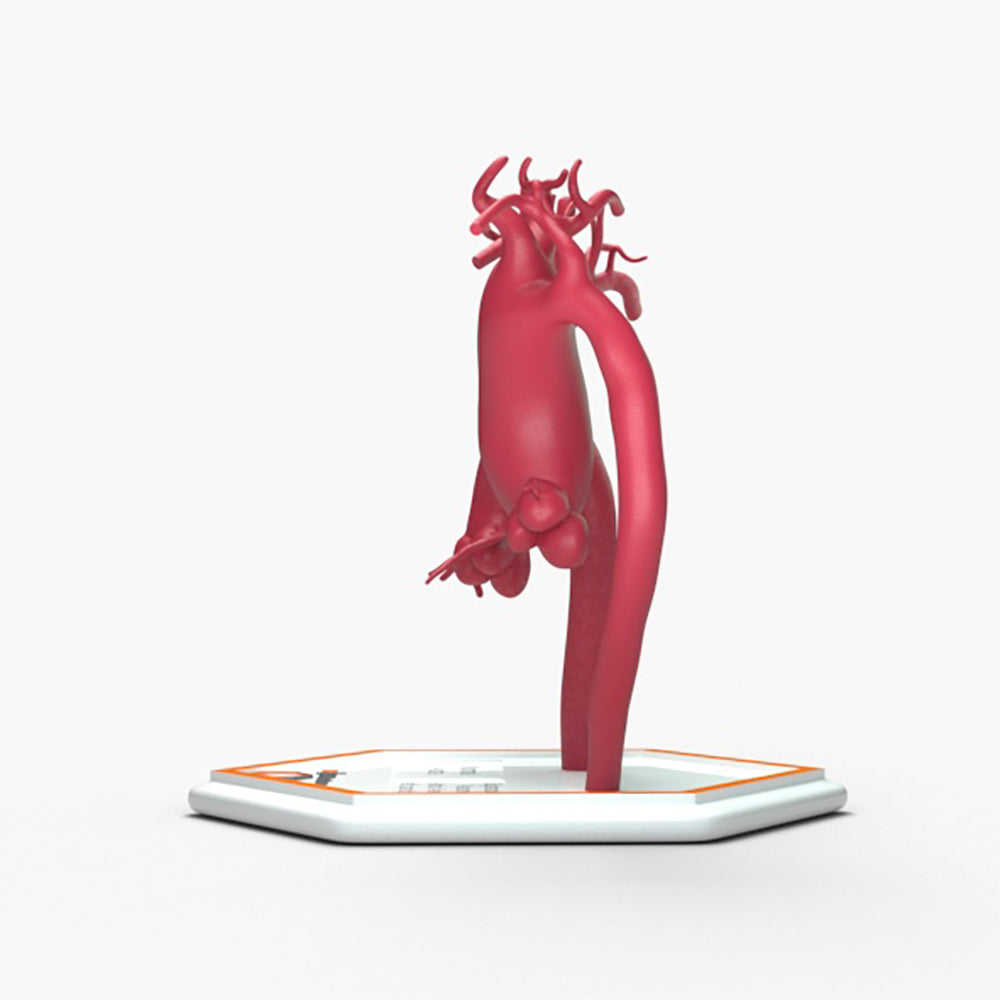 Supracoronary Ascending Aortic Aneurysm Left Carotid Variant and Normal