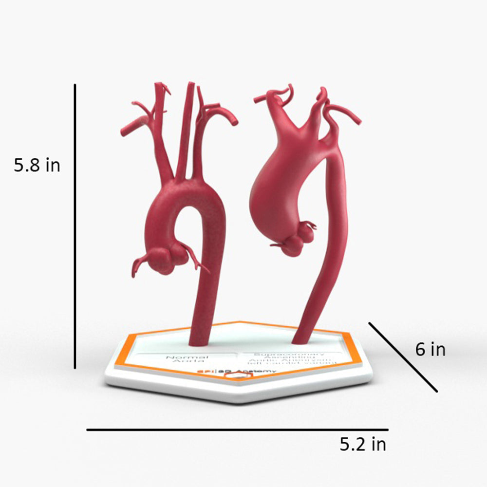 Supracoronary Ascending Aortic Aneurysm Left Carotid Variant and Normal