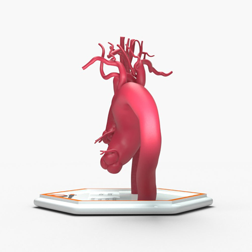 Ascending Supracoronary Aortic Arch and Innominate Artery Aneurysm and Normal