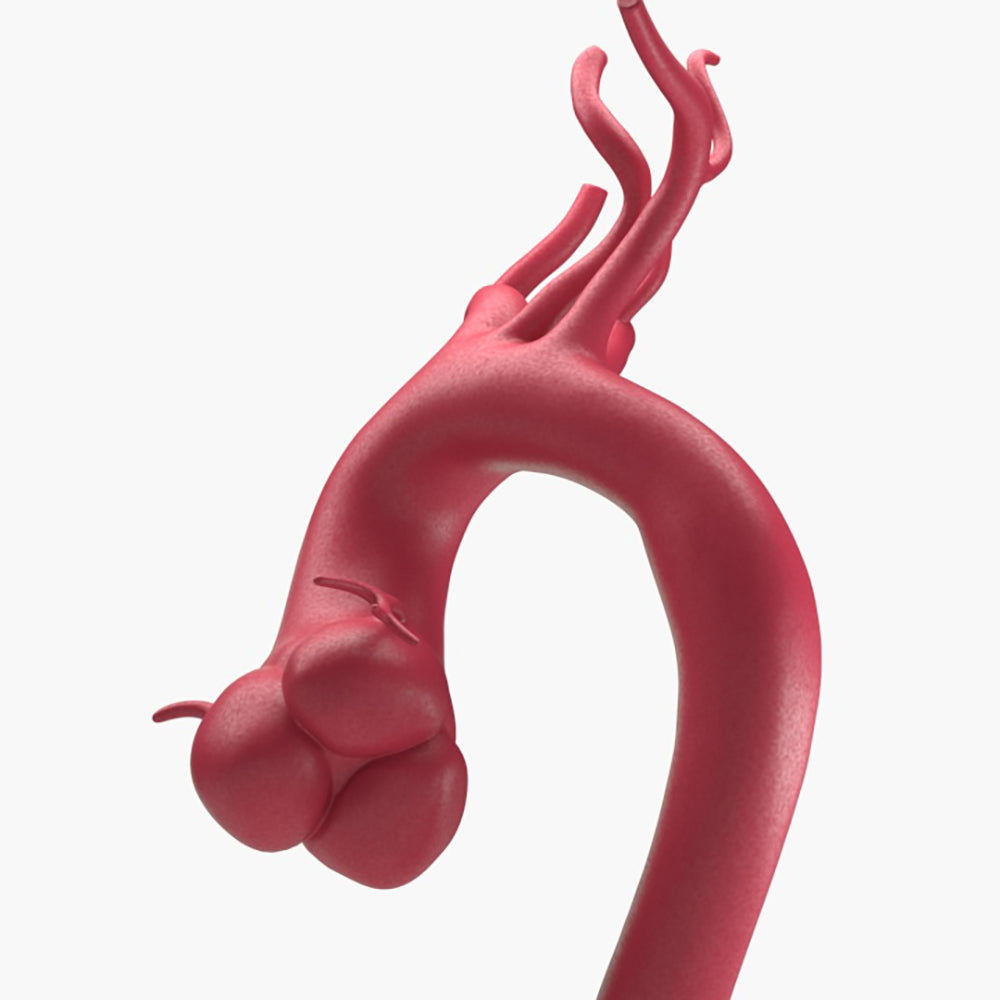Marfanoid Aortic Root Aneurysm