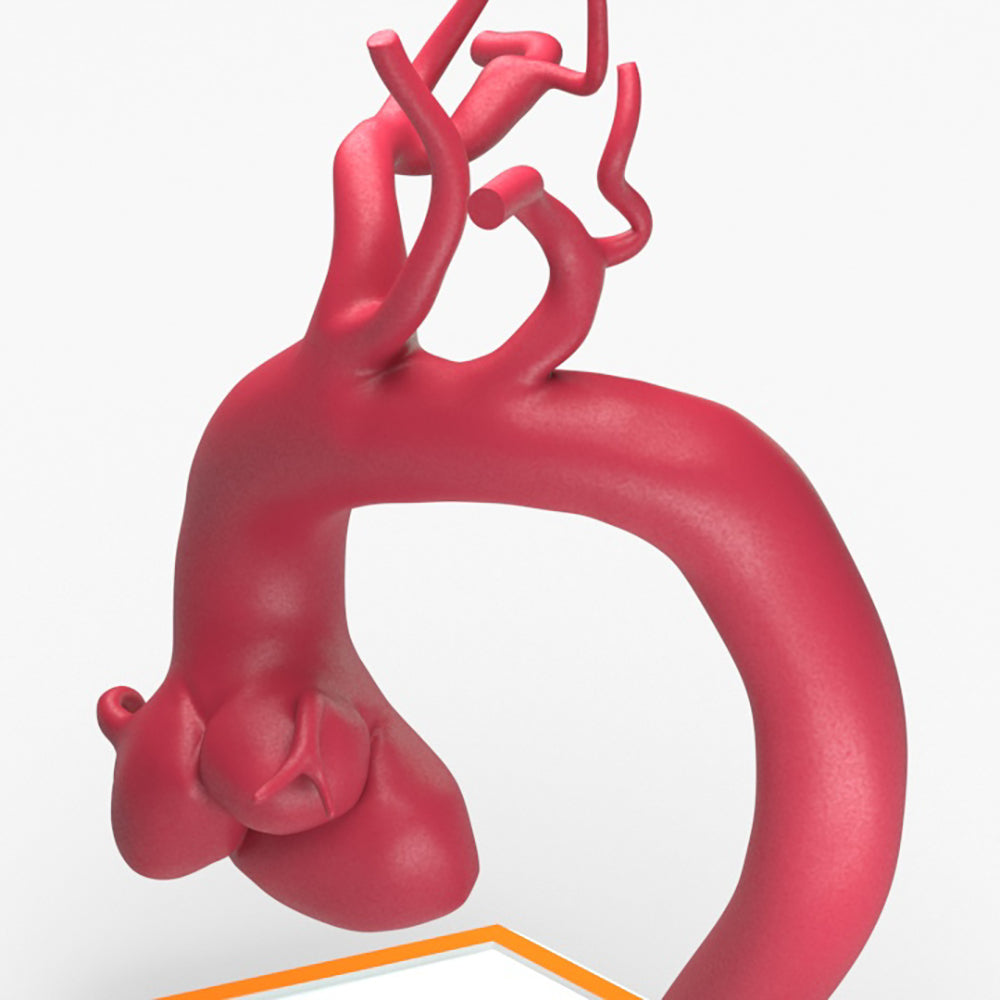 Marfanoid Aortic Root and Sinus of Valsalva Aneurysm