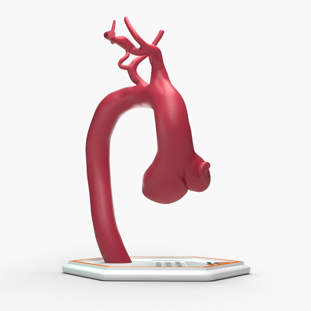 Marfanoid Aortic Root and Sinus of Valsalva Aneurysm
