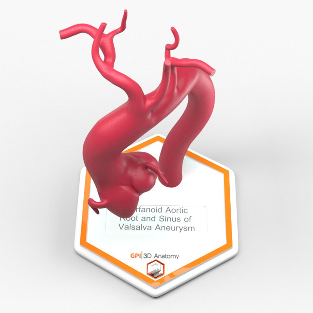 Marfanoid Aortic Root and Sinus of Valsalva Aneurysm
