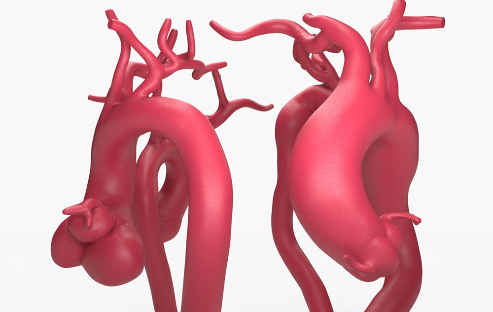 Ascending Aortic Aneurysms 2