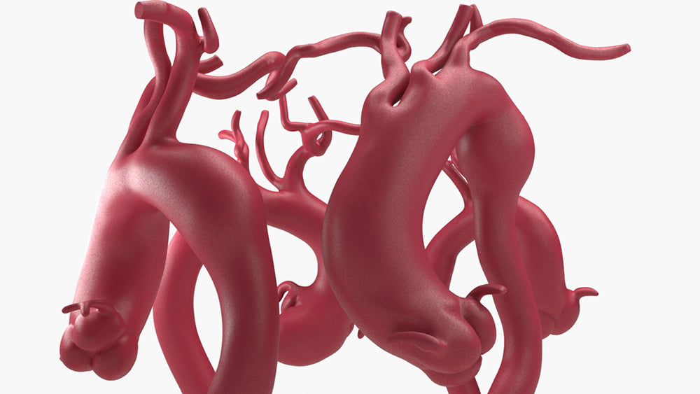 Ascending Aortic Aneurysms 2