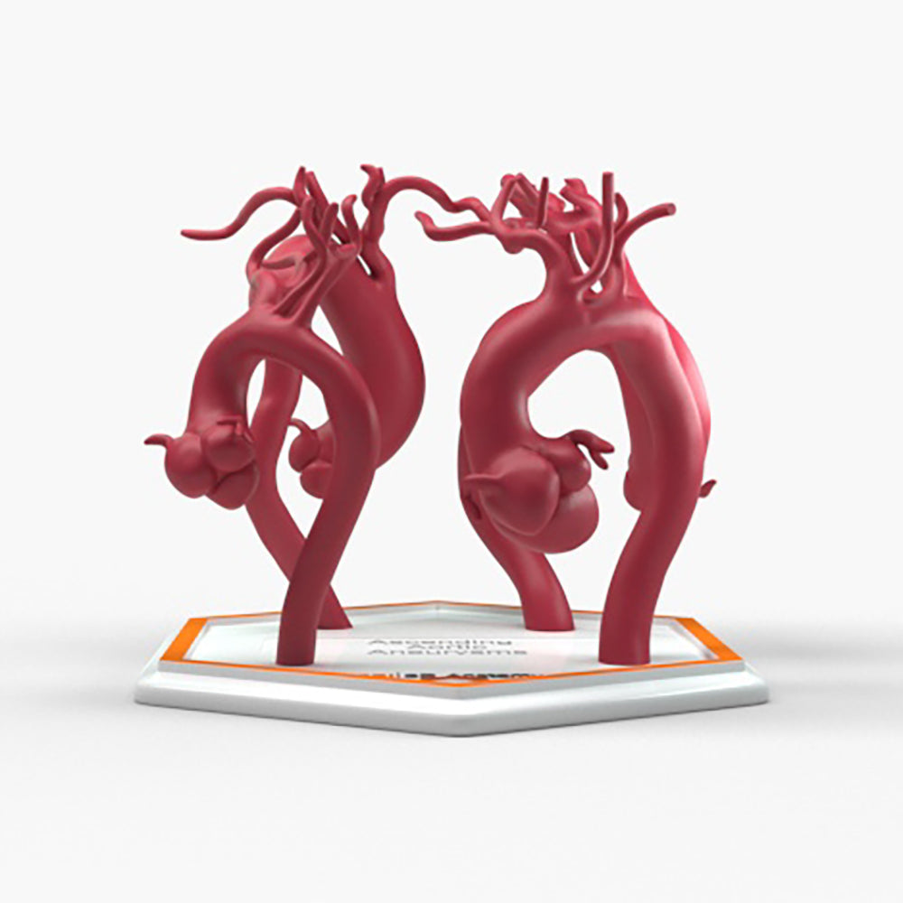 Ascending Aortic Aneurysms 2