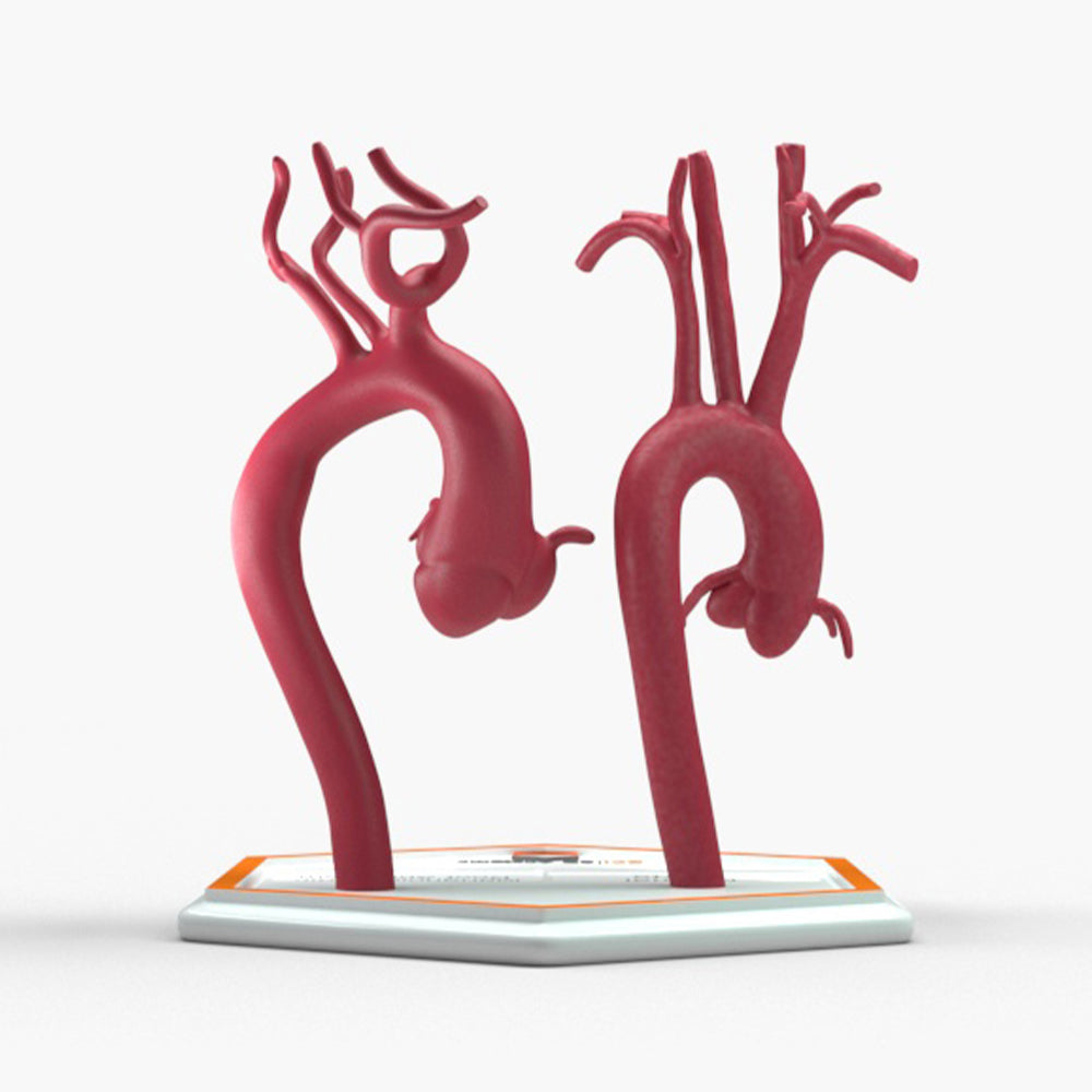 Marfanoid Aortic Root Aneurysm and Normal