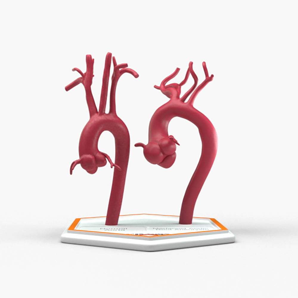 Marfanoid Aortic Root Aneurysm and Normal