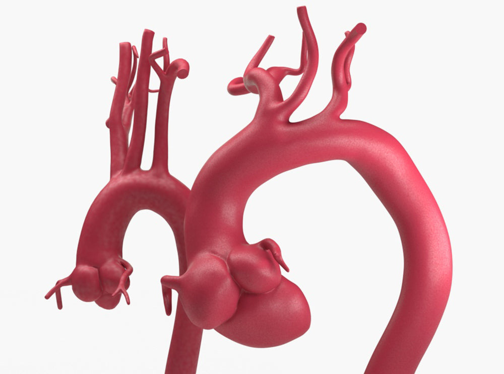 Marfanoid Aortic Root and Sinus of Valsalva Aneurysm and Normal