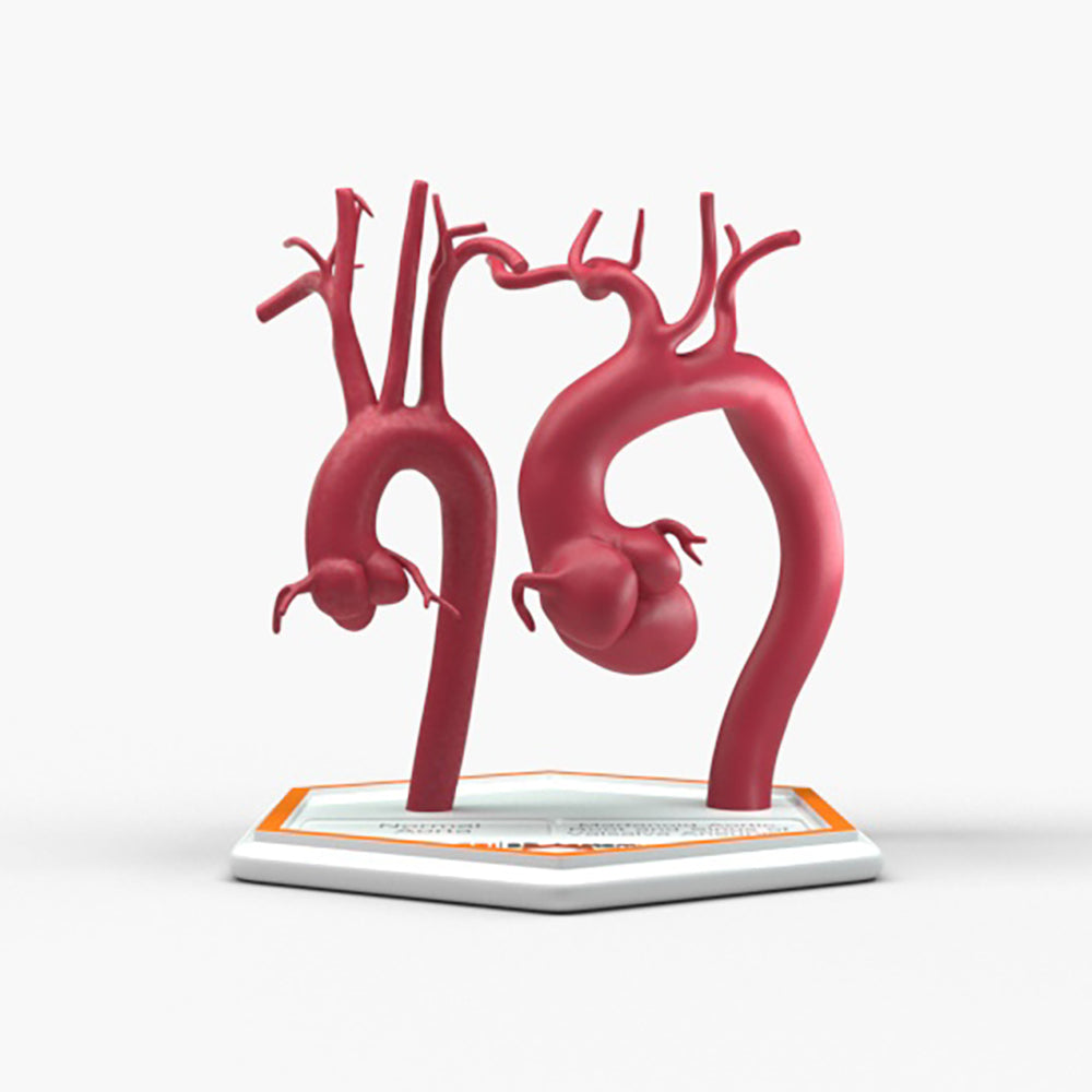Marfanoid Aortic Root and Sinus of Valsalva Aneurysm and Normal