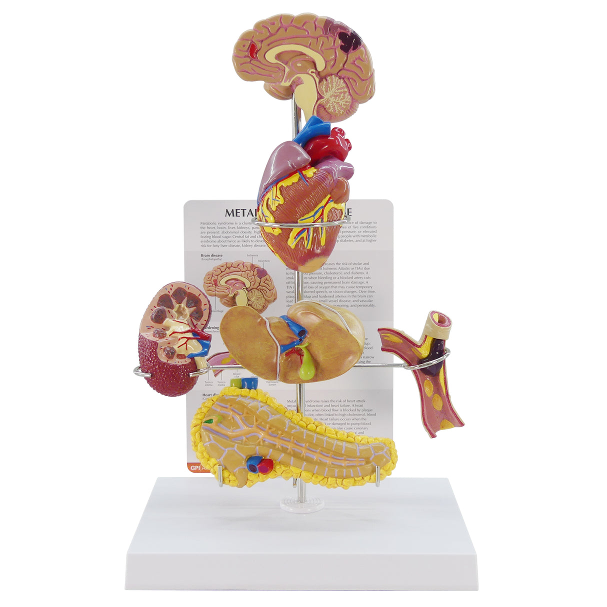 Metabolic Syndrome Model Set