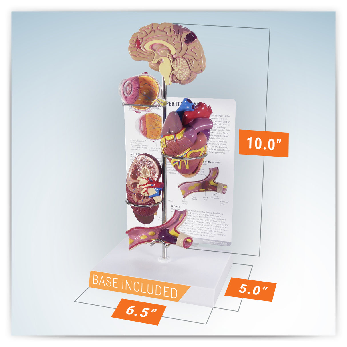 Hypertension Model Set