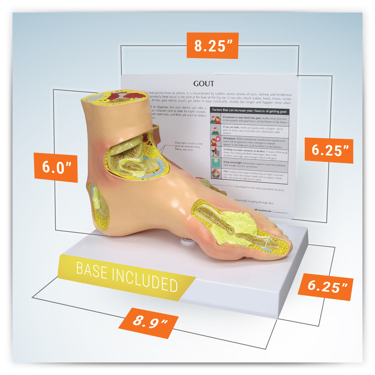 Left Foot Model with Gout