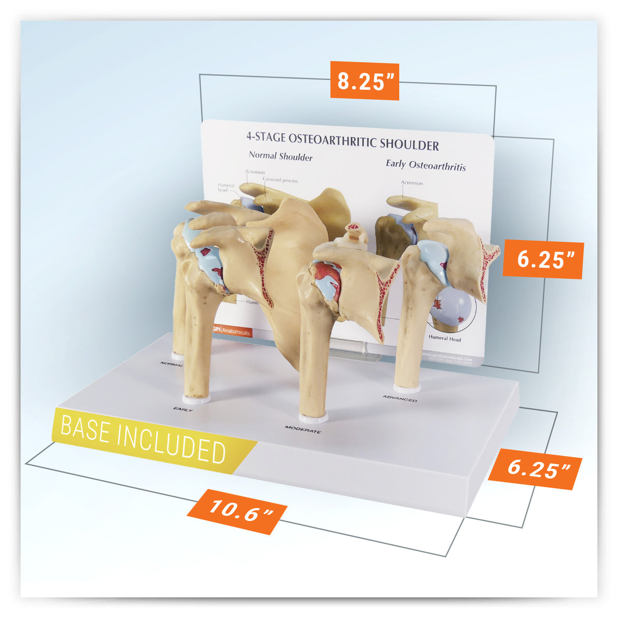 4-Stage Osteoarthritis (OA) Shoulder Model