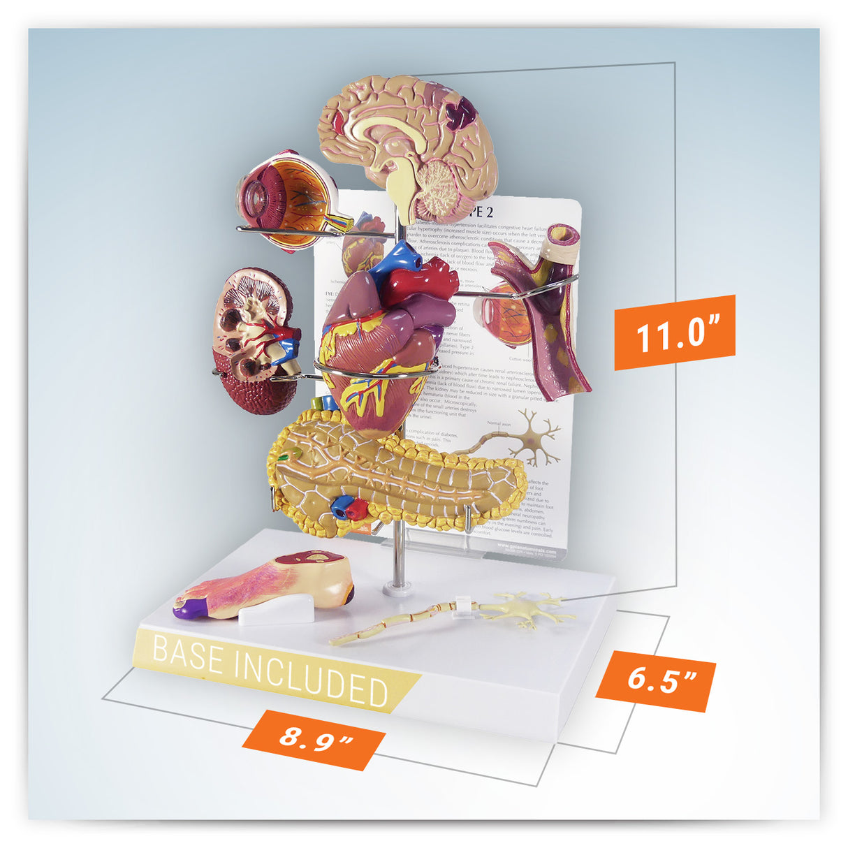 Type II Diabetes Model Set