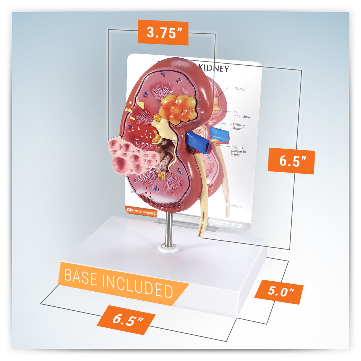 Normal and Diseased Kidney Model