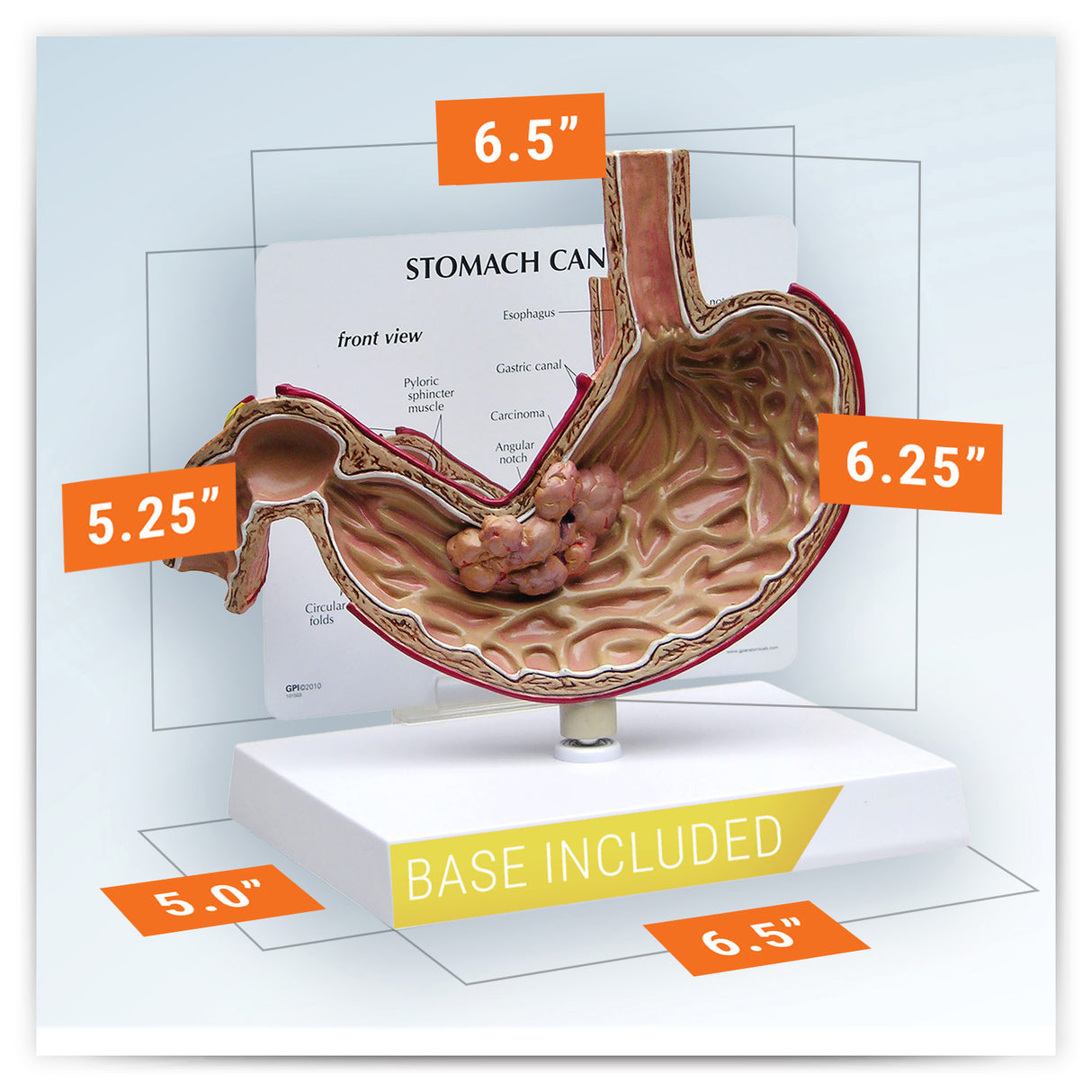 Stomach Cancer Model