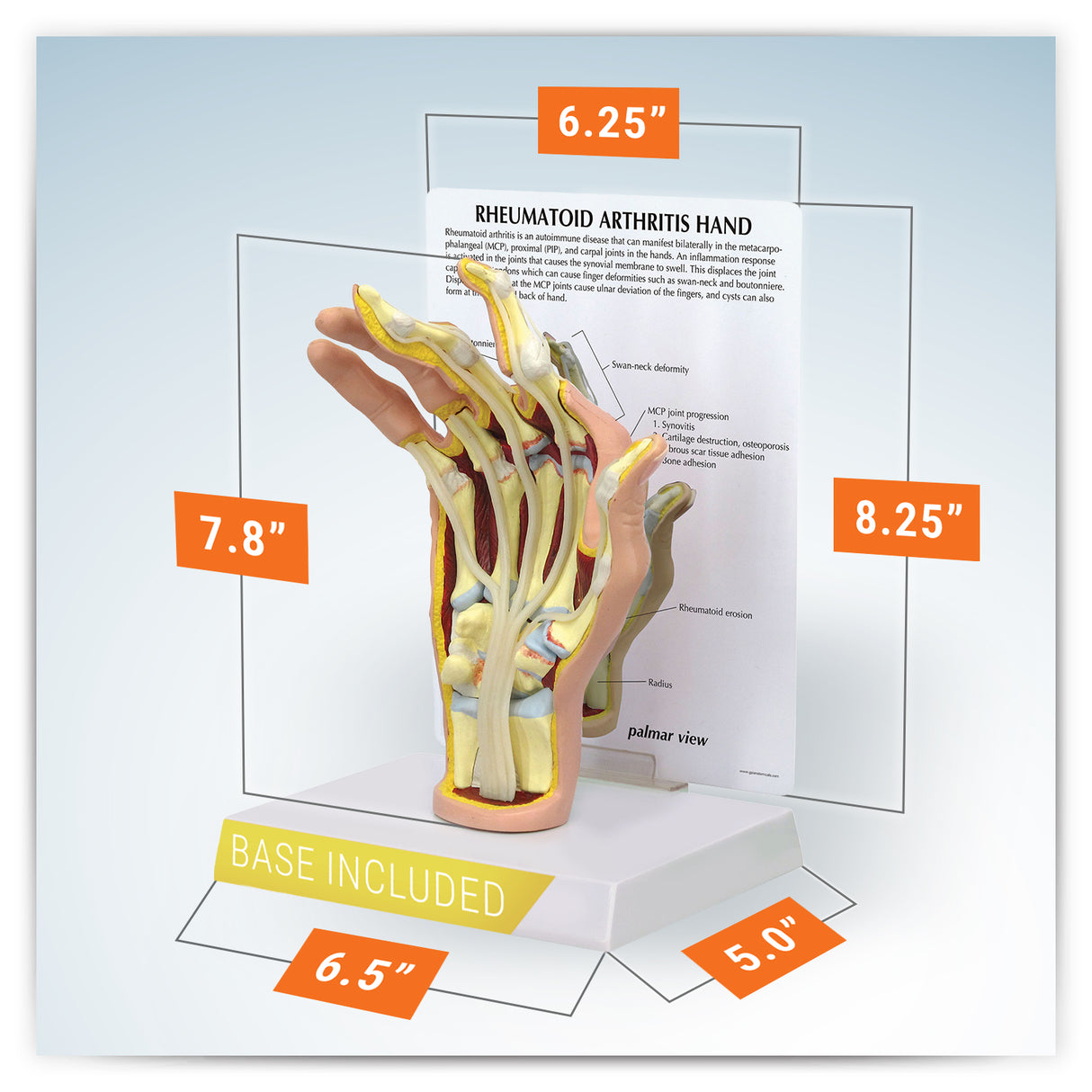 Right Hand Model with Rheumatoid Arthritis