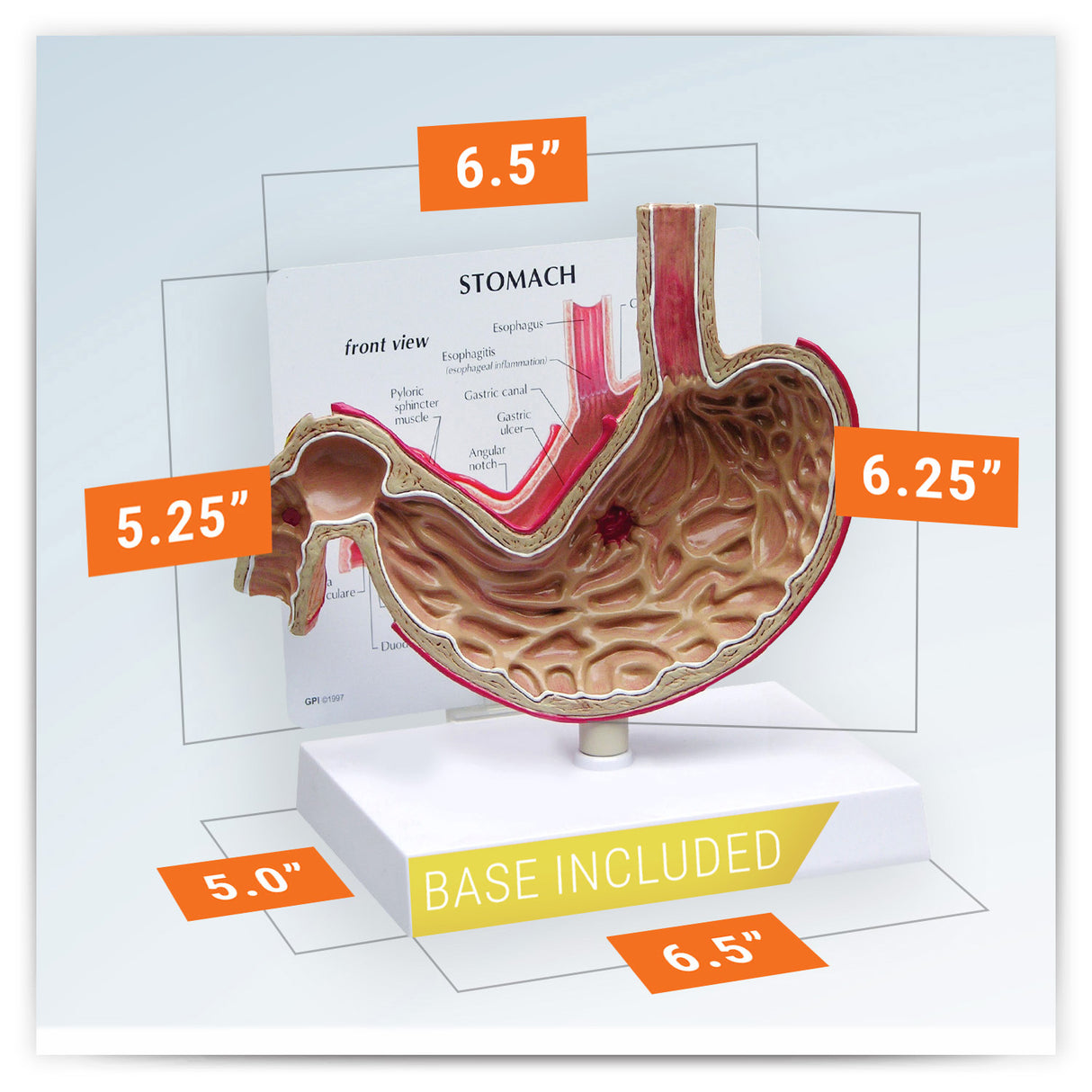 Stomach Model with Ulcers