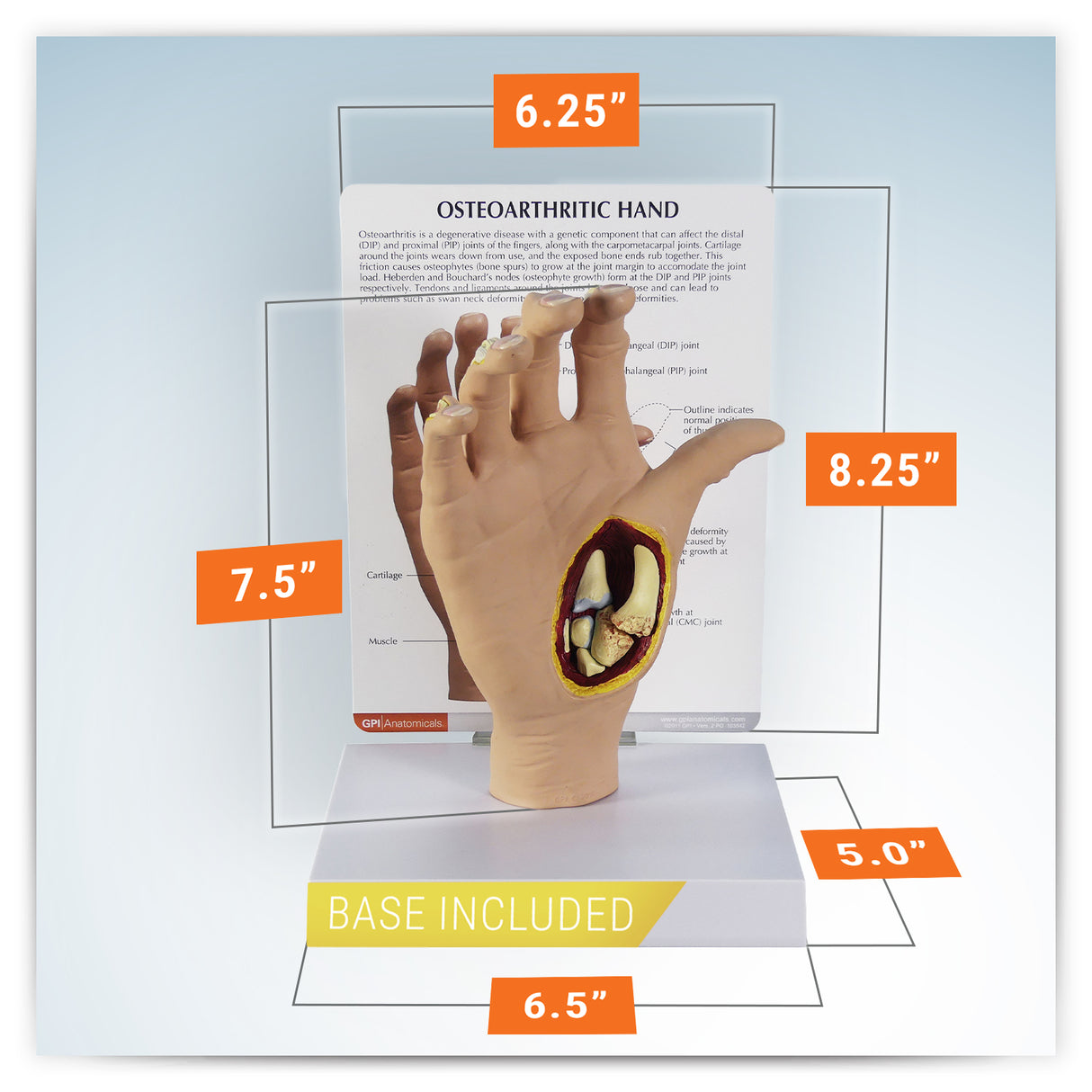Right Hand Model with Osteoarthritis (OA)