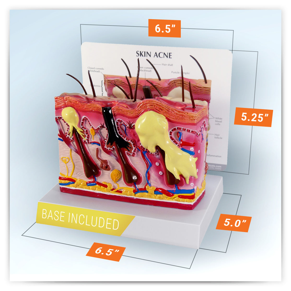 Skin Acne Cross-Section Model