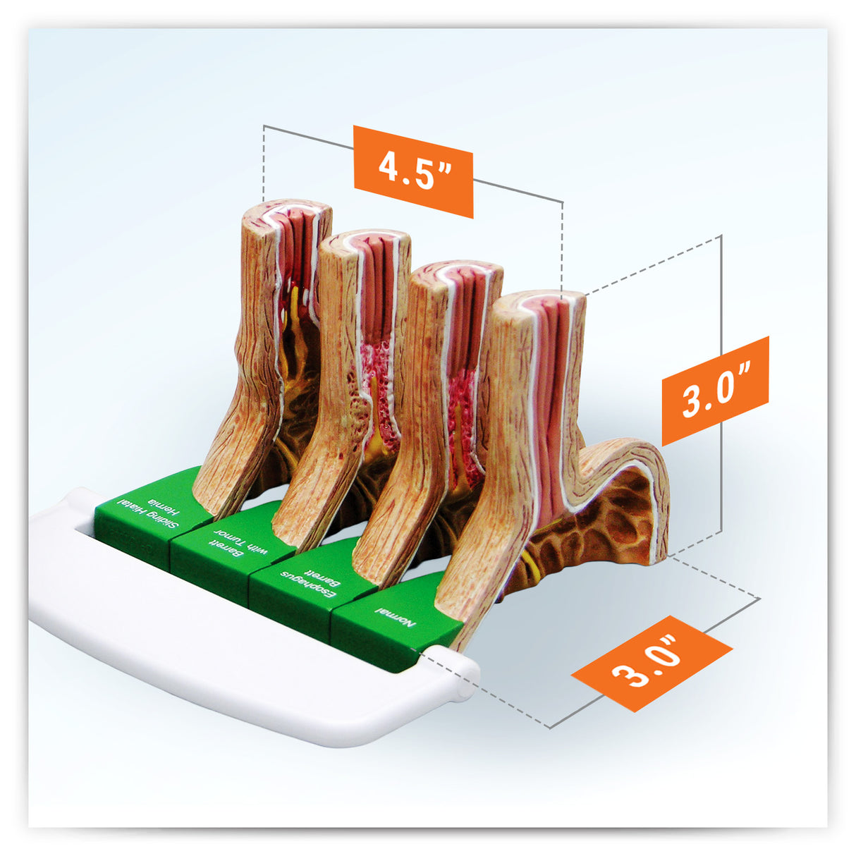 4-Piece Stomach Model Set with Gastroesophageal Reflux Disease (GERD)