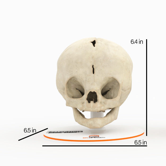 Infant Skull With Bilateral Craniosynostosis of the Coronal Suture - Female, 5 Months