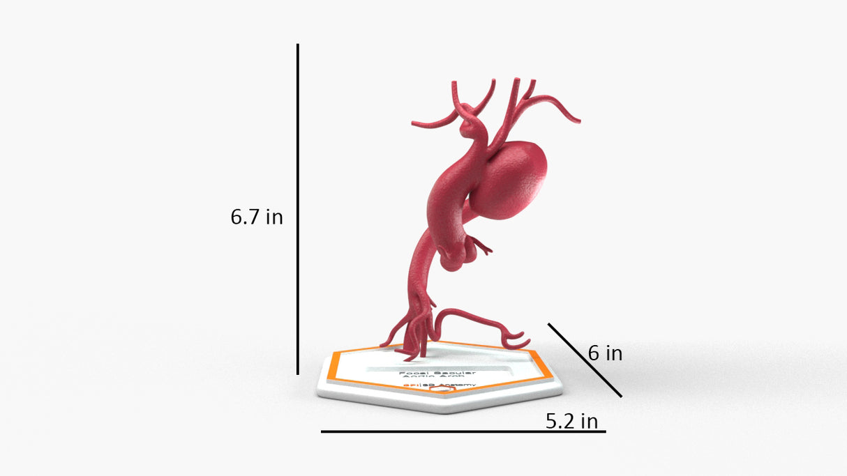 Aortic Arch - Focal Sacular Aneurysm