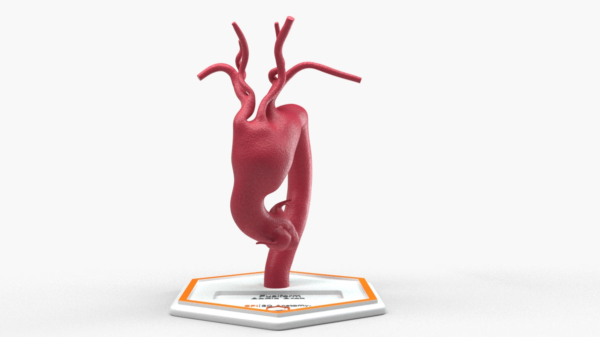 Aortic Arch - Fusiform Ascending Aneurysm