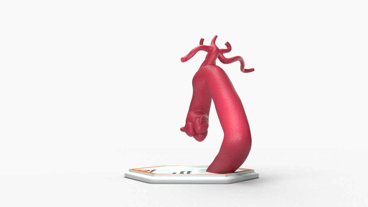 Aortic Arch - Fusiform with Proximal Descending Aneurysm