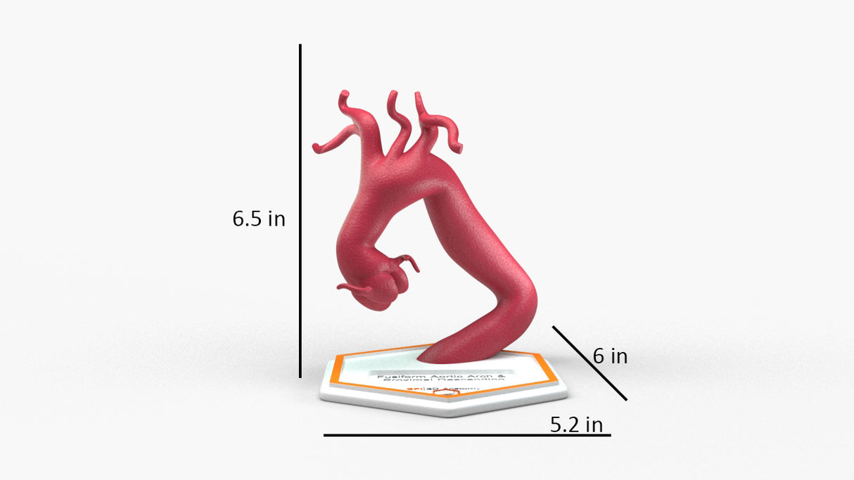 Aortic Arch - Fusiform with Proximal Descending Aneurysm