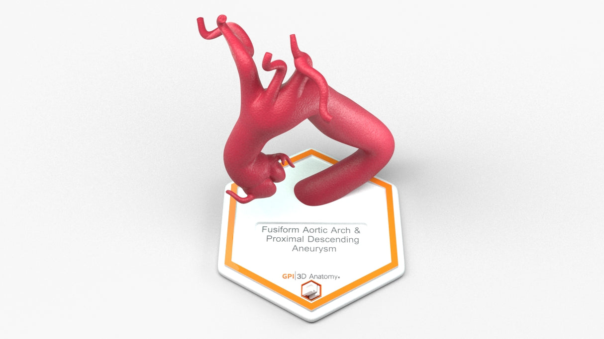 Aortic Arch - Fusiform with Proximal Descending Aneurysm