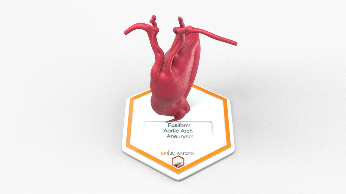 Aortic Arch - Fusiform Ascending Aneurysm