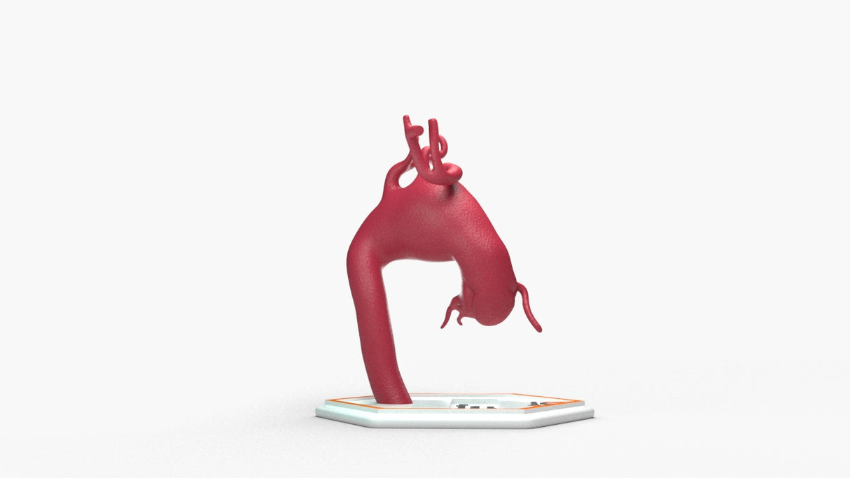 Aortic Arch - Fusiform Ascending Aneurysm