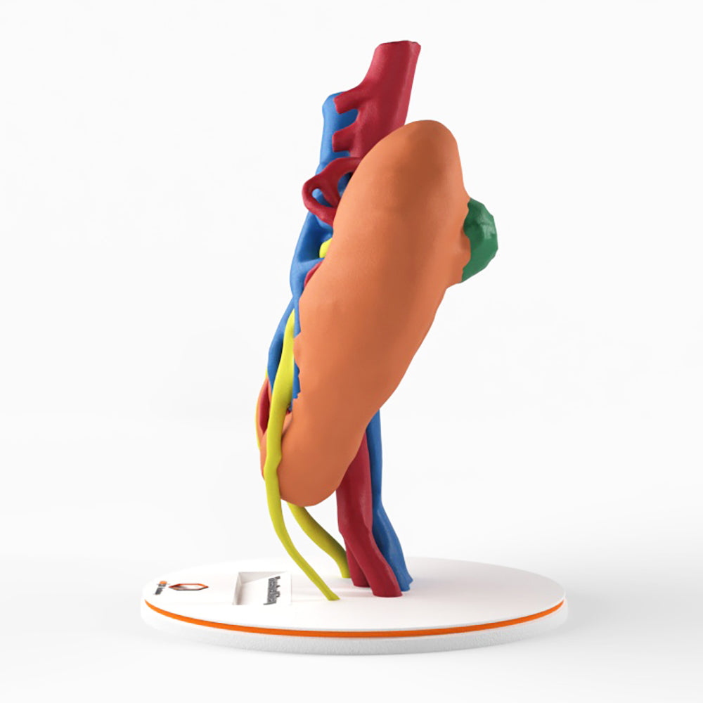 Horseshoe Kidney With Renal Cell Carcinoma (RCC) – Male, 41 Years