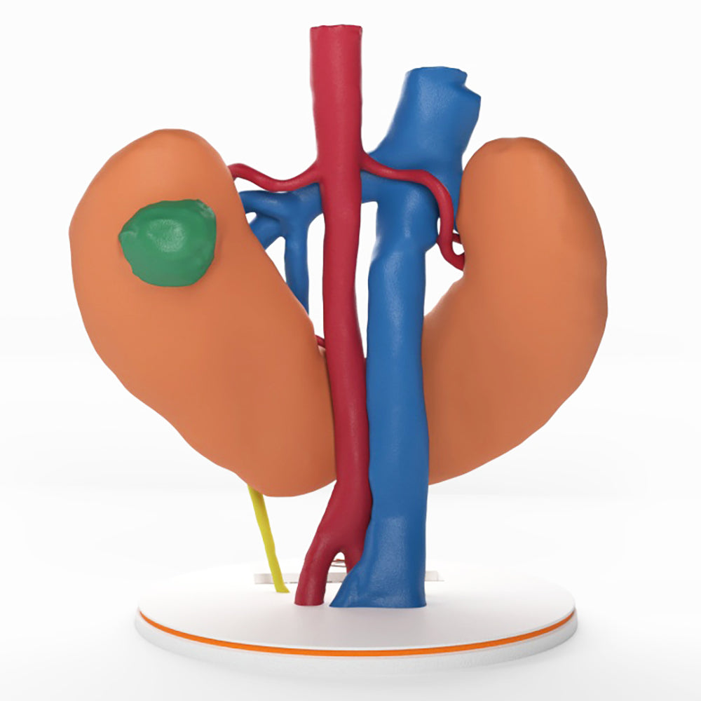 Horseshoe Kidney With Renal Cell Carcinoma (RCC) – Male, 41 Years